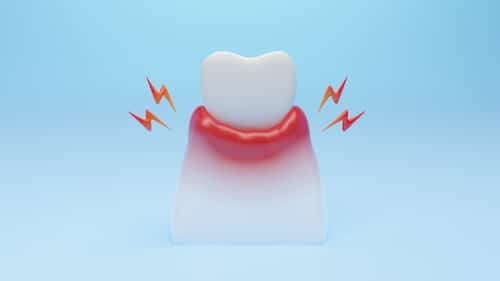 What You Need to Know Before Getting a Root Canal